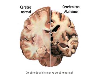En México un millón de personas padecen Alzheimer, enfermedad que se asociaría con alto consumo de grasas